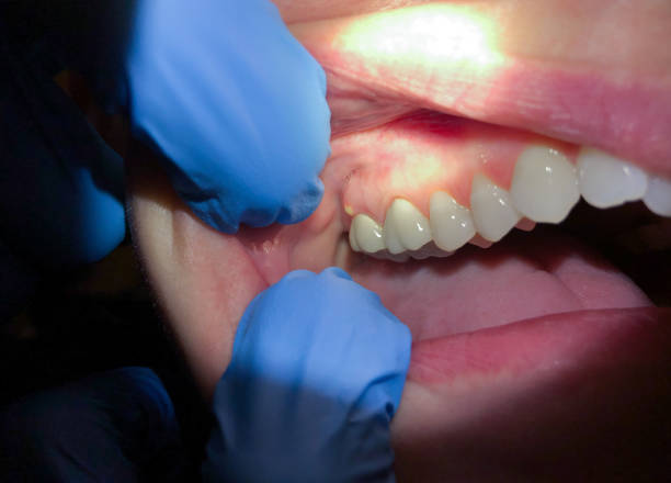 Best Emergency Cosmetic Dentistry (e.g., broken veneers) in Whitemarsh Island, GA